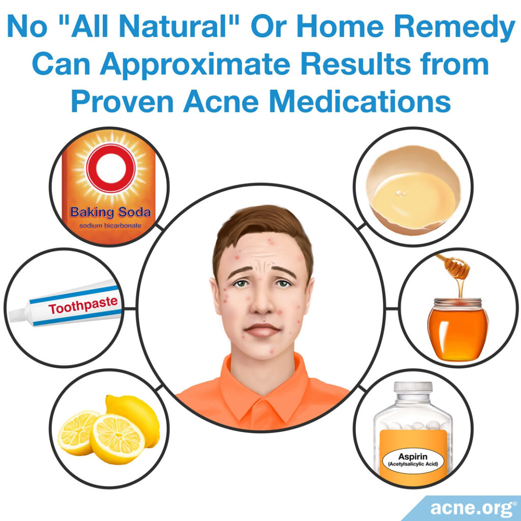 Natural Treatments For Acne: Home Remedies That Deliver Results