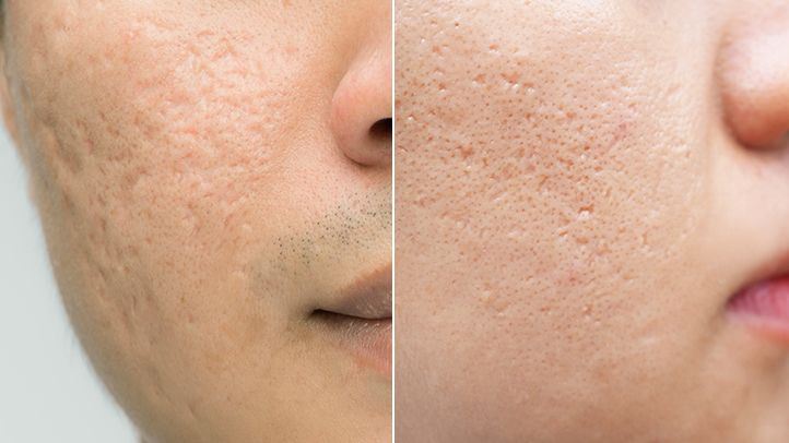 Pimple Scar Removal: Regaining Clearer Skin Confidence