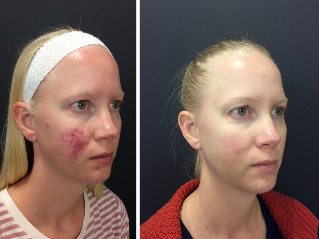 Pimple Scar Removal: Regaining Clearer Skin Confidence