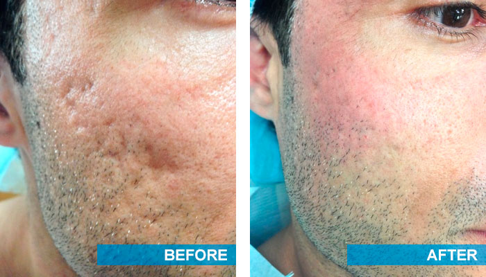 Pimple Scar Removal: Regaining Clearer Skin Confidence