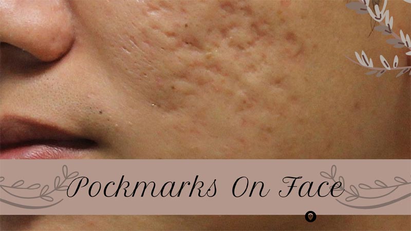 Pockmarked Face: Causes And Solutions For Smoother Skin