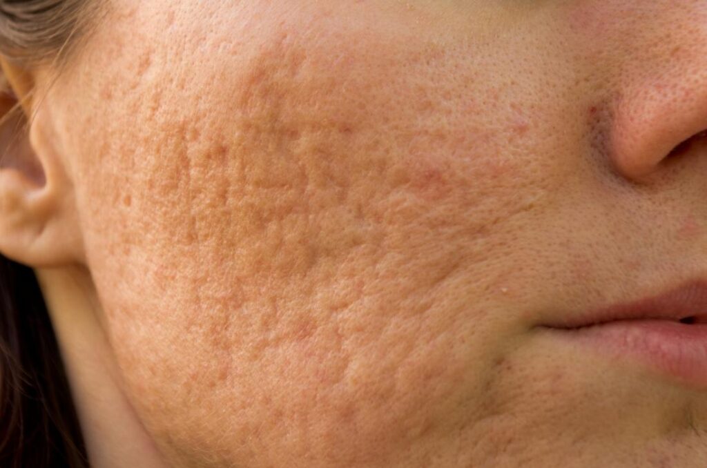 Pockmarked Face: Causes And Solutions For Smoother Skin
