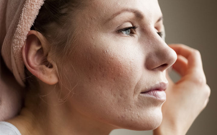 Pockmarked Face: Causes And Solutions For Smoother Skin