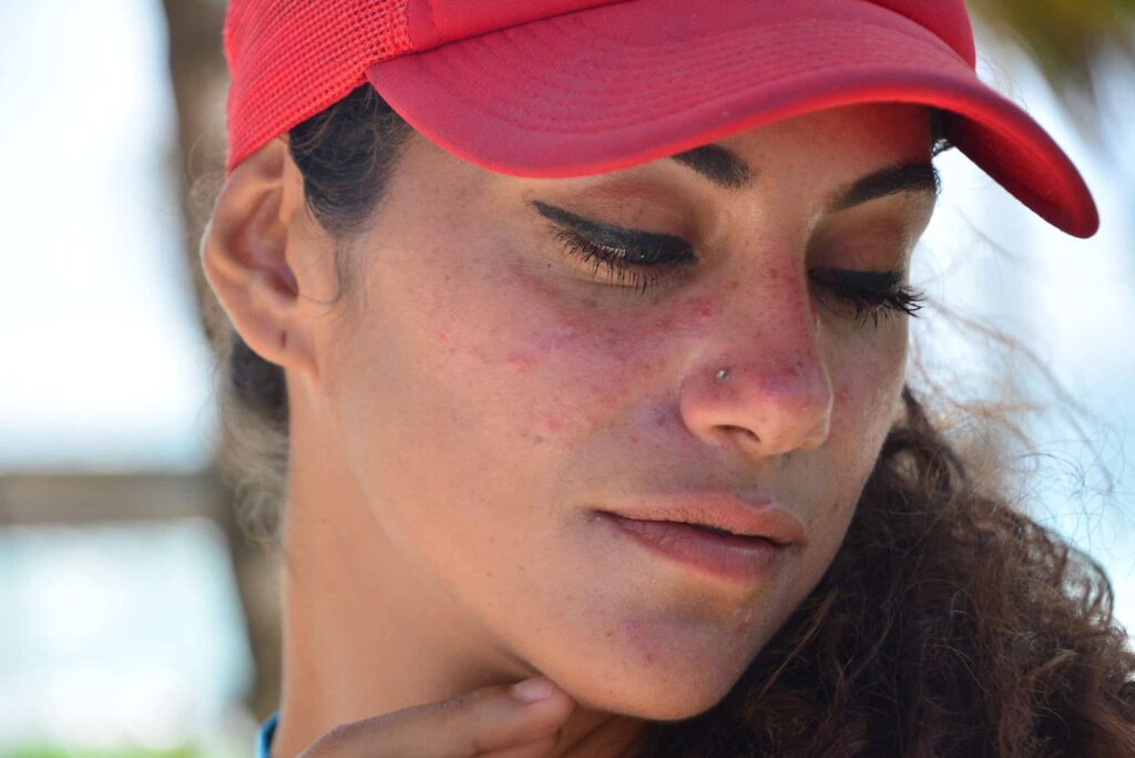 Scarred Face: Coping And Treating Facial Scarring