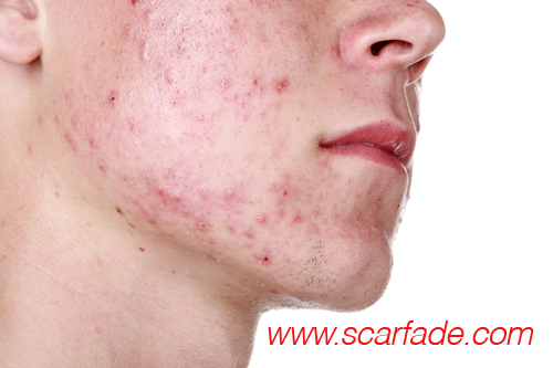 Scarred Face: Coping And Treating Facial Scarring