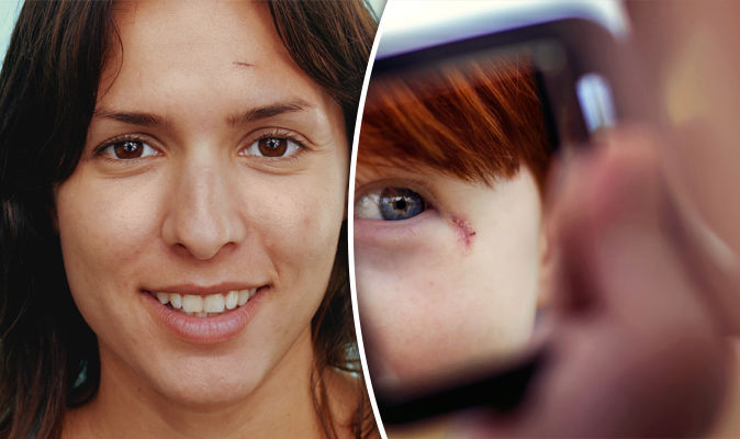 Scarred Face: Coping And Treating Facial Scarring