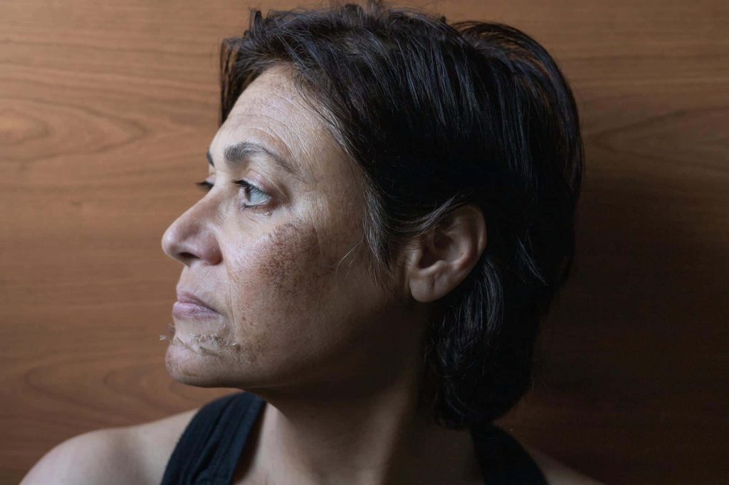 Scarred Face: Coping And Treating Facial Scarring