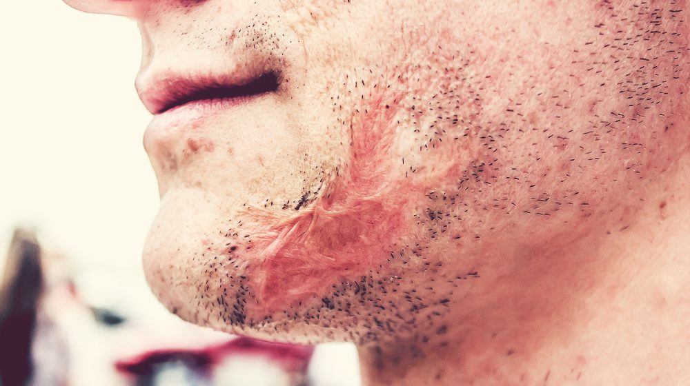 Scarred Face: Coping And Treating Facial Scarring