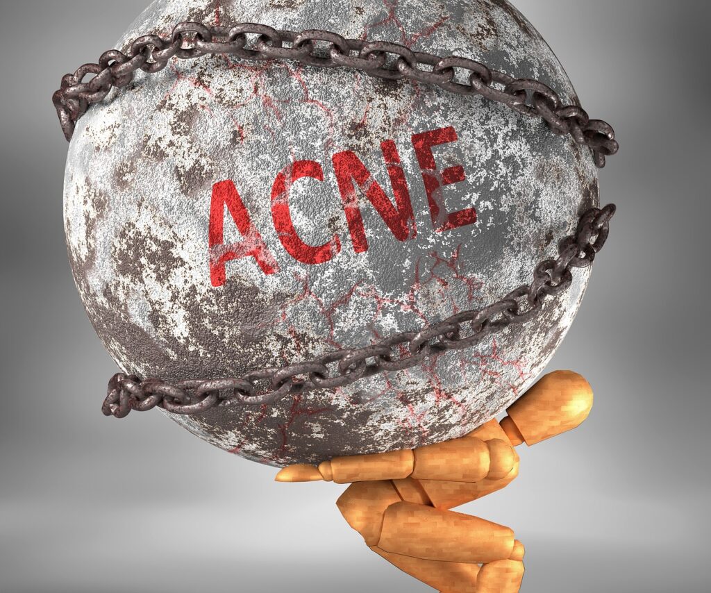 Acne Dark Spot Treatment: Brighten Your Skin With These Tips