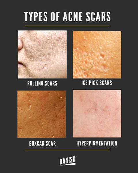 Banish Bacne Scars: Effective Treatment Options