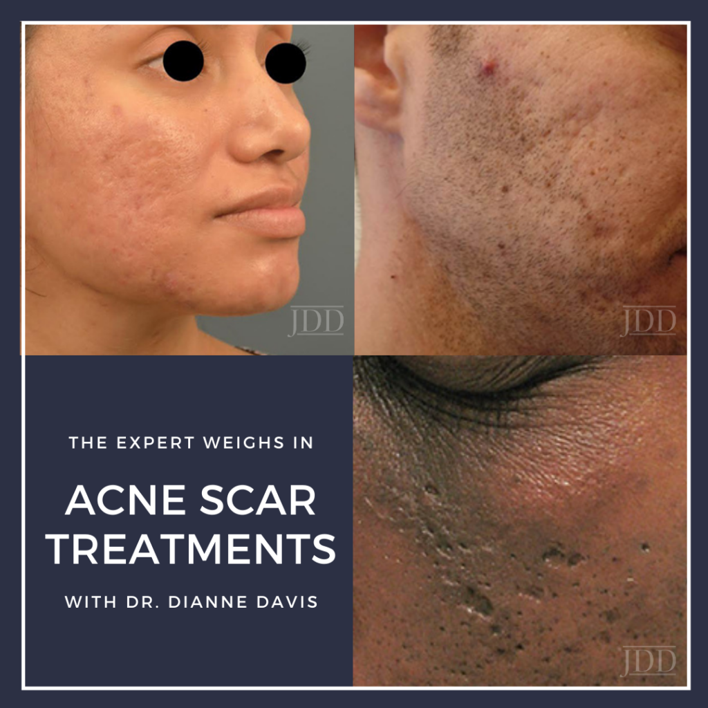Choosing The Best Treatment For Acne Scars: Your Skins New Ally