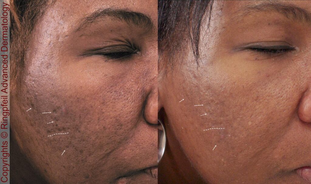 Choosing The Best Treatment For Acne Scars: Your Skins New Ally