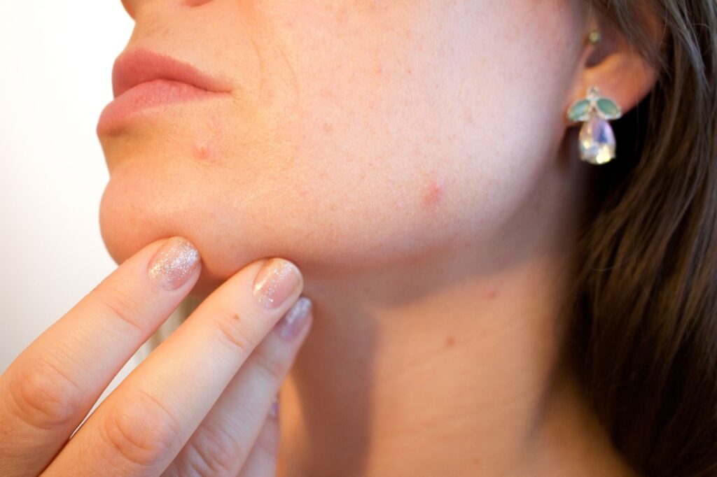 Do Acne Scars Go Away? Understanding Long-Term Outcomes
