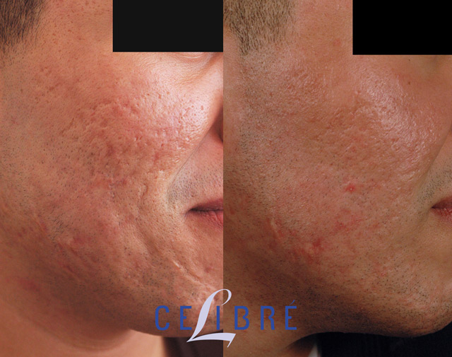 How To Get Rid Of Acne Scars: Effective Strategies That Work