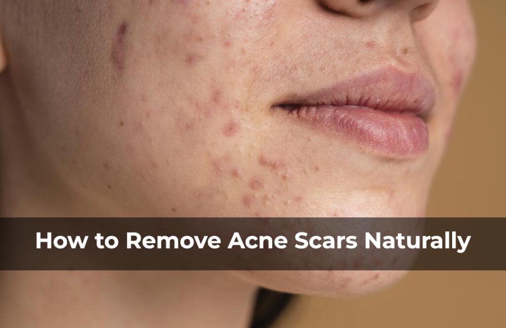 How To Get Rid Of Acne Scars: Effective Strategies That Work
