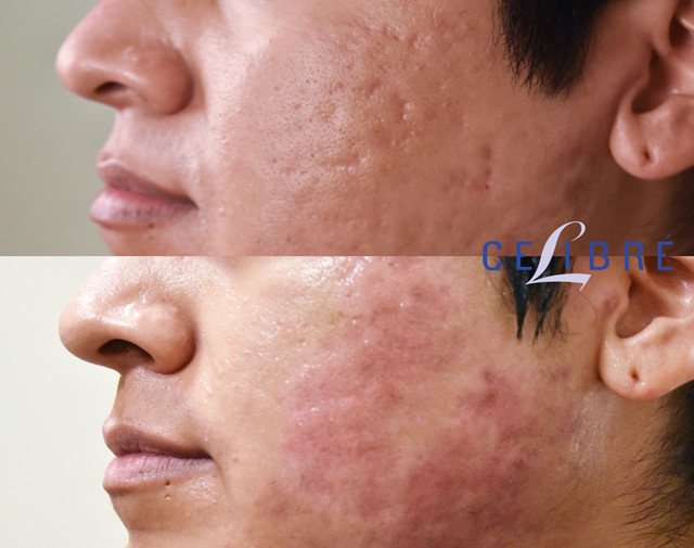 How To Get Rid Of Acne Scars: Effective Strategies That Work