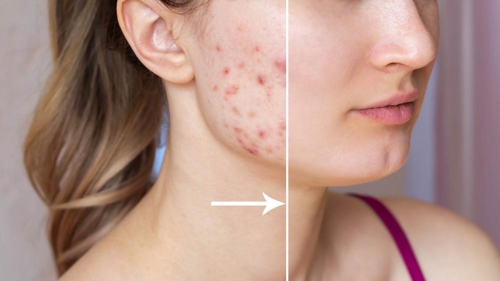 How To Get Rid Of Acne Scars: Effective Strategies That Work