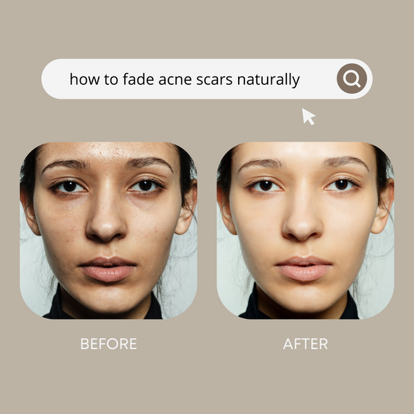 How To Get Rid Of Acne Scars: Effective Strategies That Work