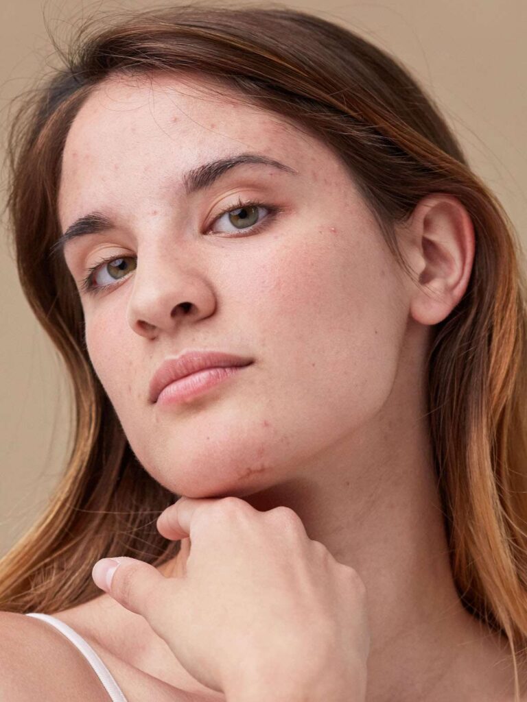 How To Get Rid Of Pimple Scars: Expert-Backed Strategies