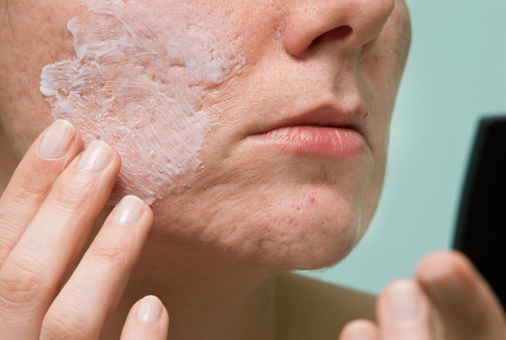 How To Remove Acne Scars: Effective Techniques For Clear Skin