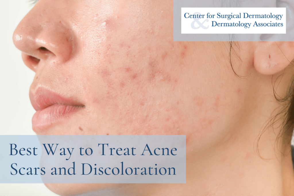 How To Remove Acne Scars: Effective Techniques For Clear Skin