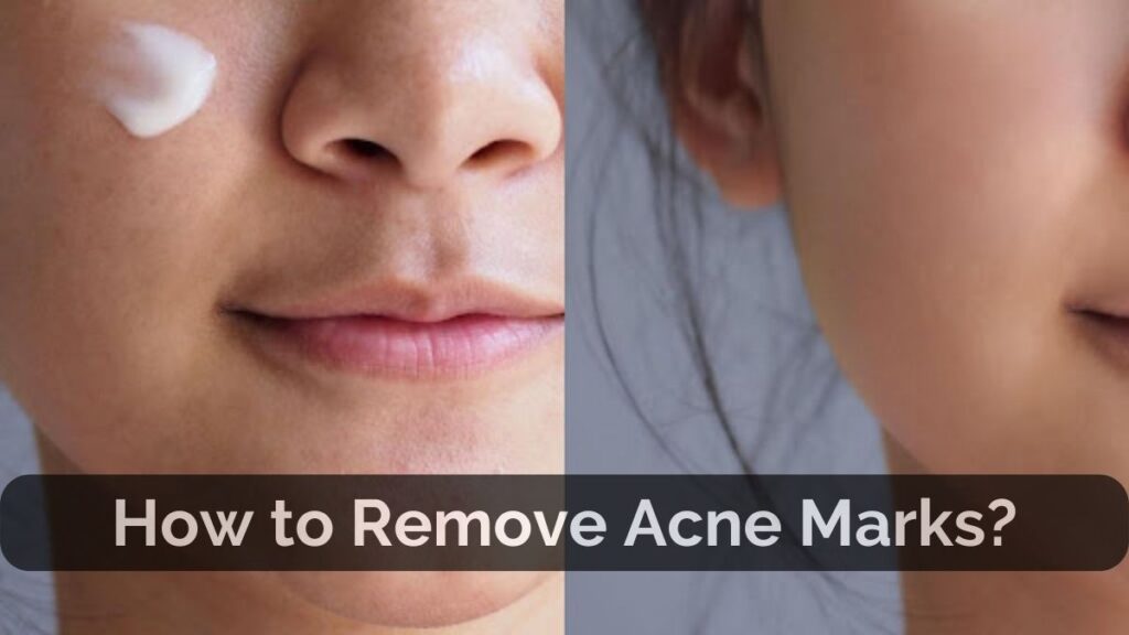 How To Remove Acne Scars: Effective Techniques For Clear Skin