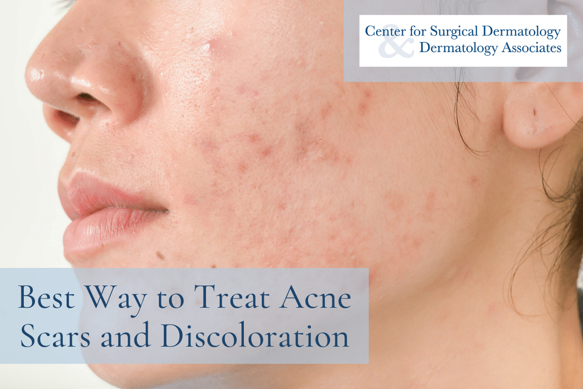 How To Remove Acne Scars: Effective Techniques For Clear Skin
