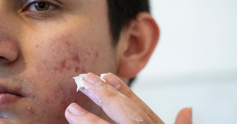 How To Remove Acne Scars: Effective Techniques For Clear Skin