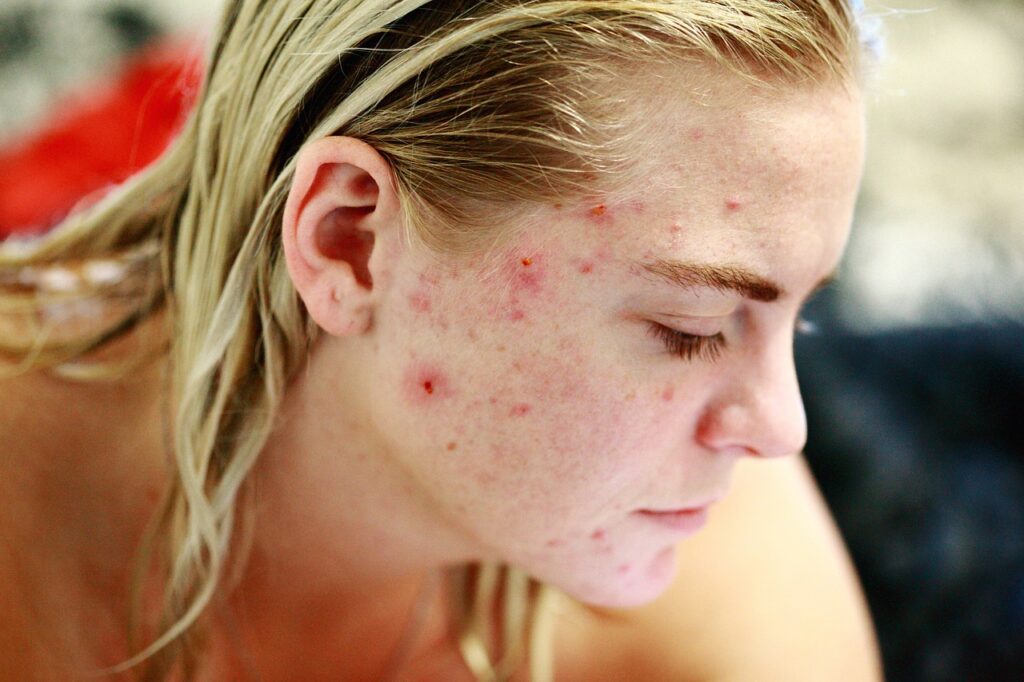 Pimples Removal: Effective Strategies For Blemish-Free Skin