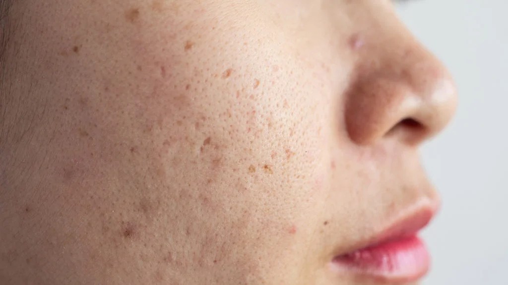 Understanding Hyperpigmentation Acne Scars: Causes And Solutions Understanding Hyperpigmentation Acne Scars: Causes And Solutions
