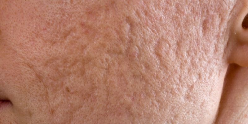 What Causes Face Craters? Understanding Post-Acne Indentations