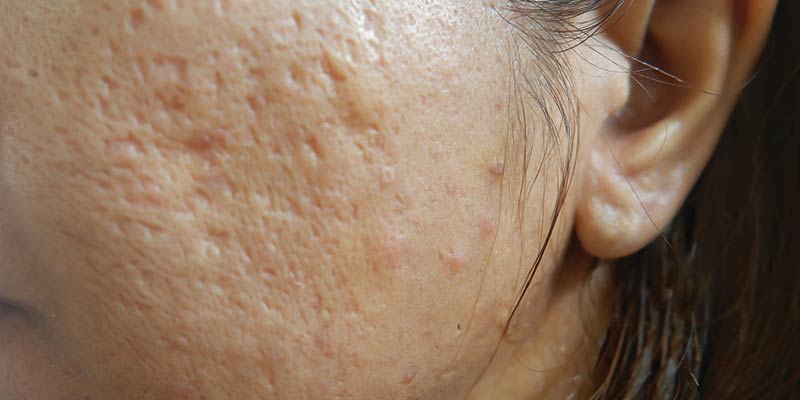 What Causes Face Craters? Understanding Post-Acne Indentations