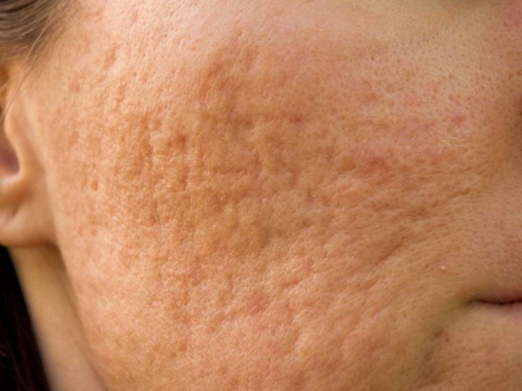 What Causes Face Craters? Understanding Post-Acne Indentations