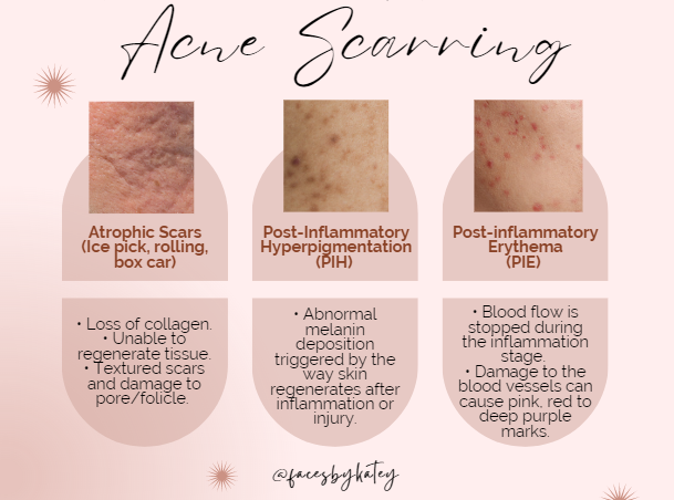 What Causes Face Craters? Understanding Post-Acne Indentations